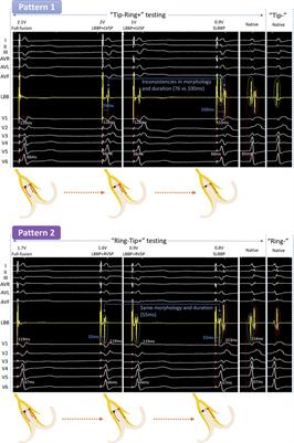 Six transition patterns and seven capture types in different left bundle branch bipolar pacing configurations